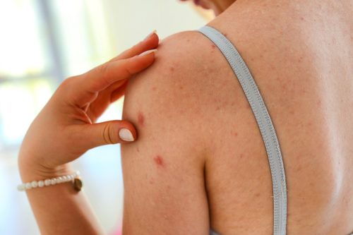 Woman's back displaying acne spots