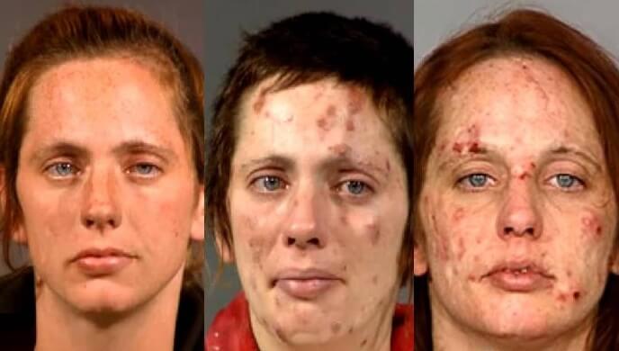 meth pock marks meth pock marks