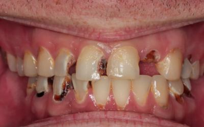 crystal meth tooth decay